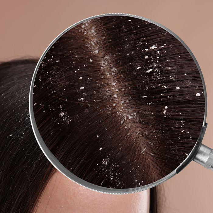 Lucovitaal Shampoo Bij Schilfertjes 200 Ml