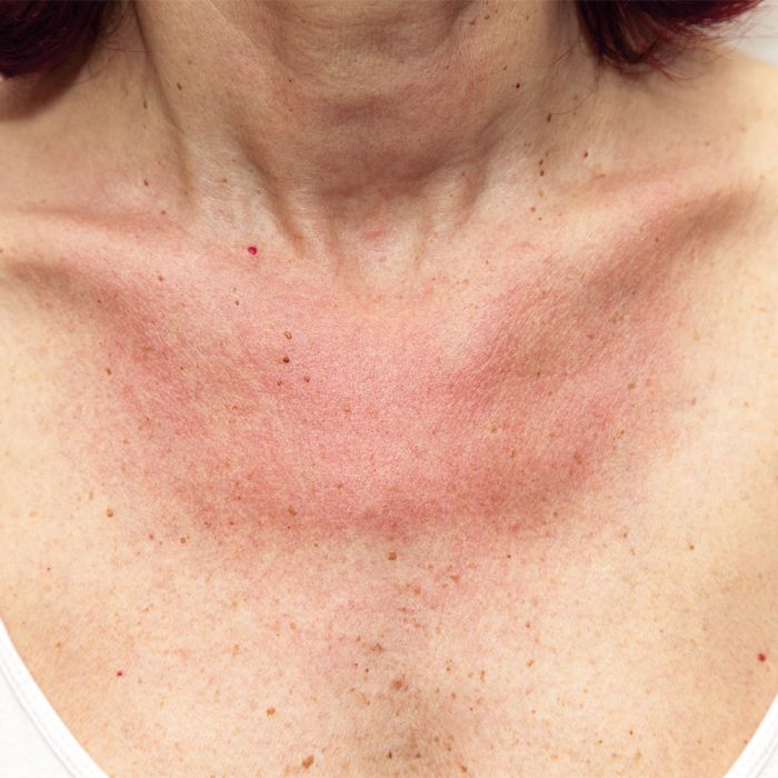 Lucovitaal Zonneallergie Crème 100 Ml